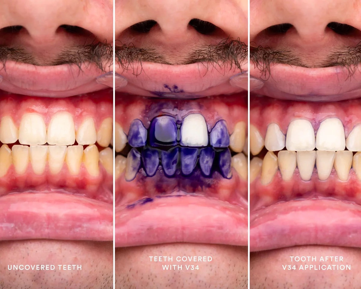 Hismile v34 Color Corrector